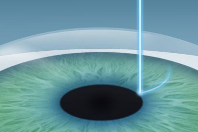 Schematische Darstellung einer Augenlaserbehandlung der Hornhaut