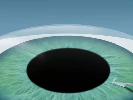 EVO Visian ICL – Behandlungsschritt 1