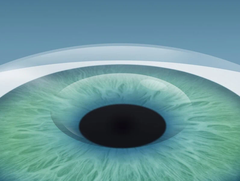 Femto-LASIK – Behandlungsschritt 3